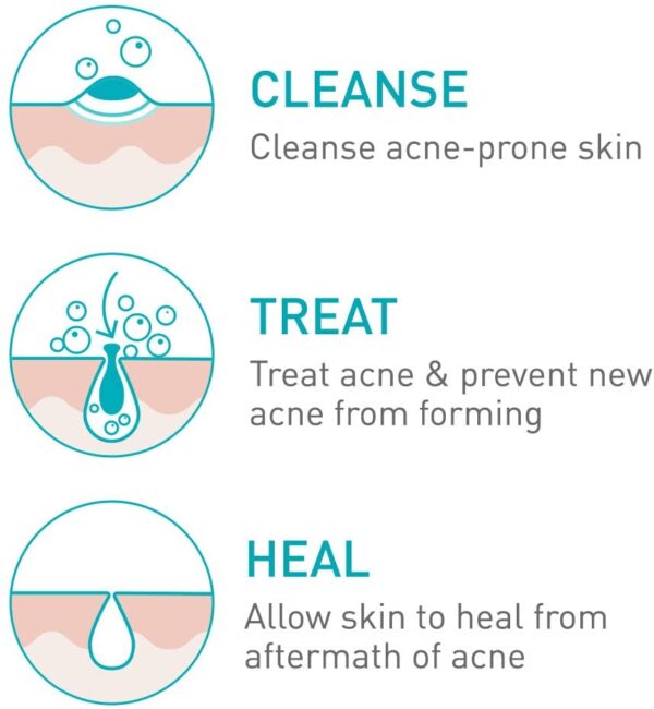 CeraVe 4% Benzoyl Peroxide ACNE Treatment Foaming Cleanser Face & Body  Wash, with Hyaluronic Acid and Niacinamide. Helps Clear Acne Pimples and